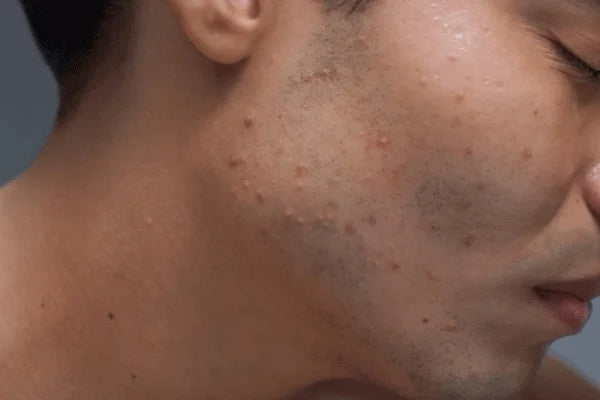 Skincare Mistakes That Are Damaging Your Skin Without You Realizing